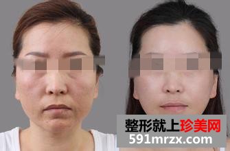 光子嫩肤效果能持续多久？