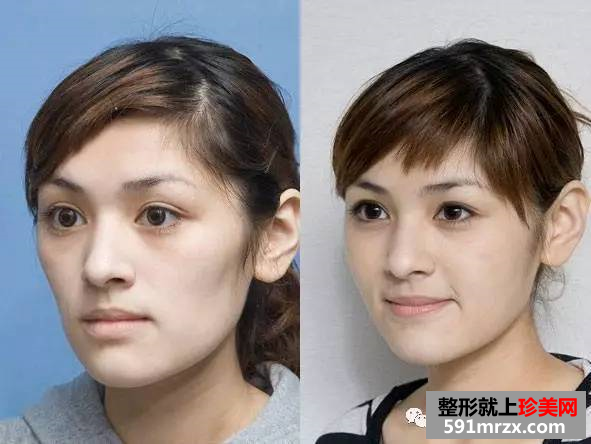 面部凹陷想填充，怎样选择填充材料