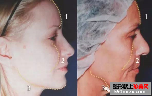 面部凹陷想填充，怎样选择填充材料