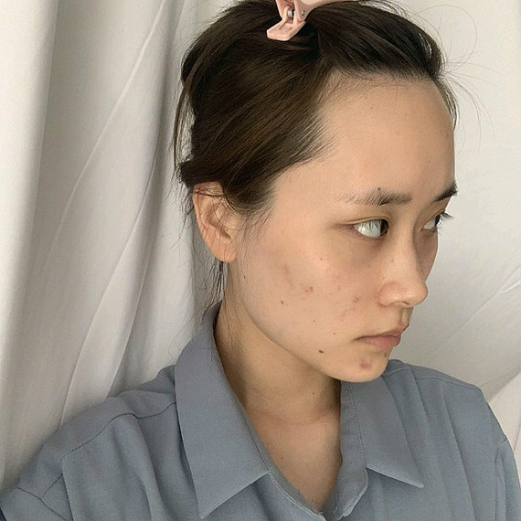 做一次玻尿酸垫下巴，魅力无穷