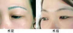 激光洗完眉毛几天能好